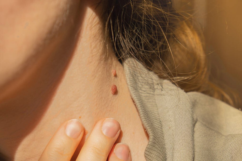 Папилломы, родинки или бородавки — что именно нужно удалять?